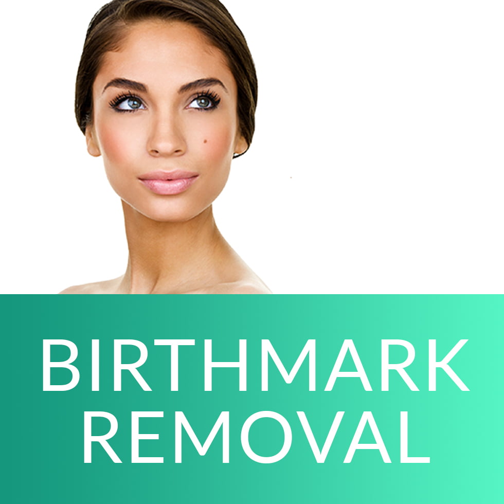 birthmark removal