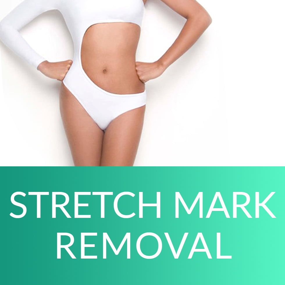 stretch mark removal